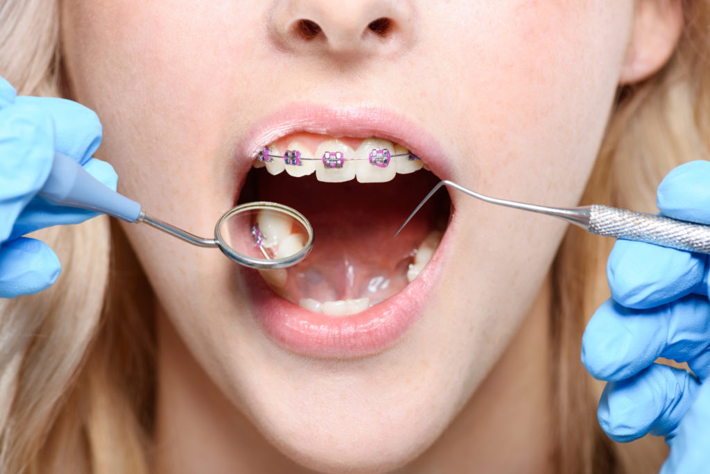 Can I Get Braces If I Have Crowns or Implants?